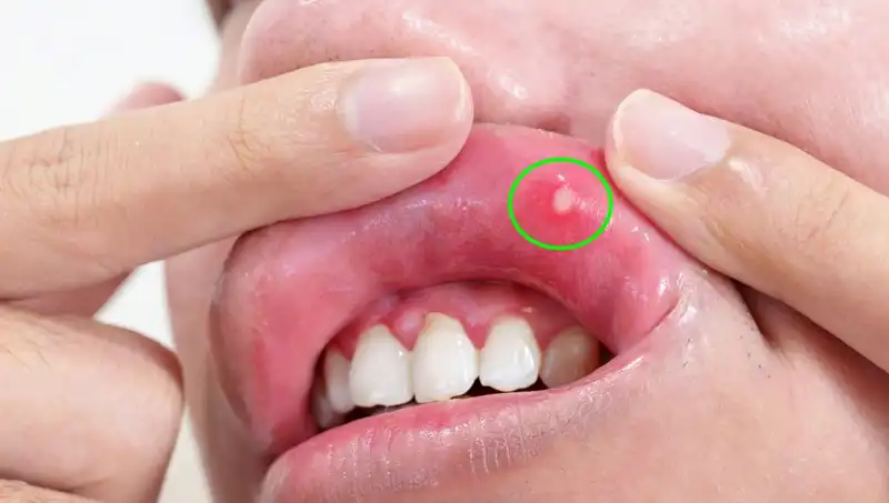 B Vitamini Eksikliği: Vücudunuzun Gösterdiği 5 Belirgin İşaret